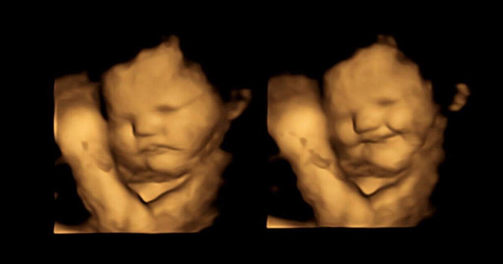 4D Ultraschall lachendes Baby