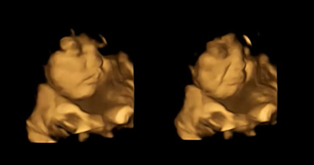4D Ultraschall weinendes Baby